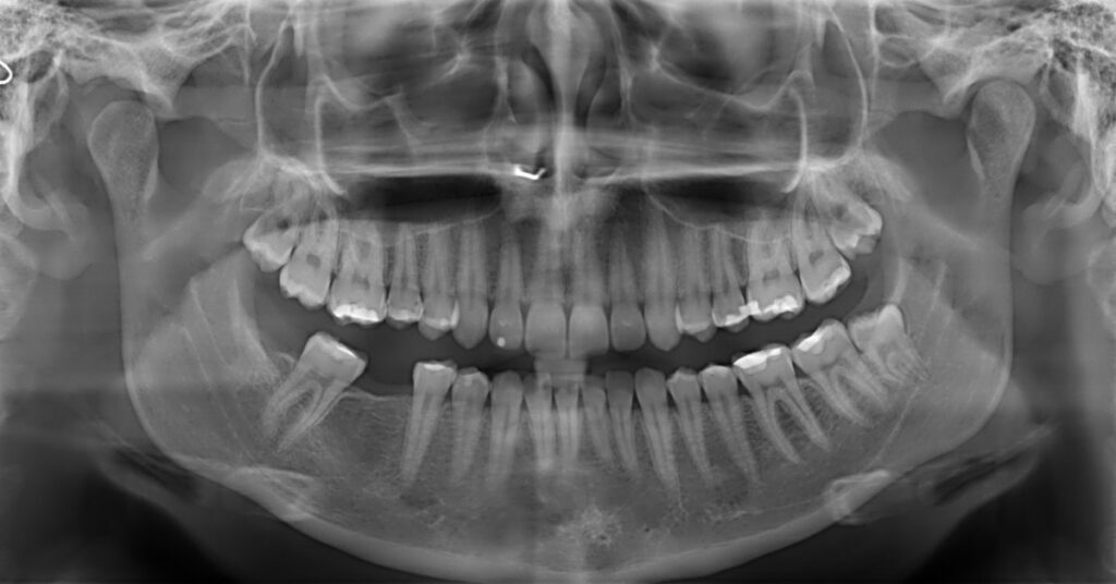 radiografia-denti