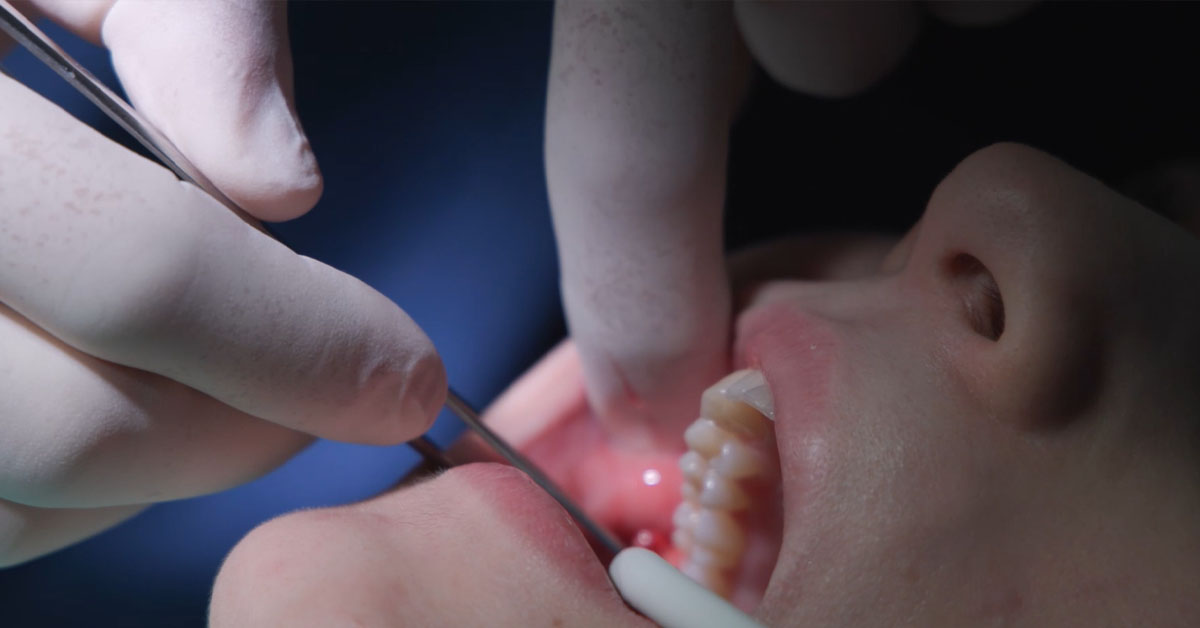 estrazione dentale
