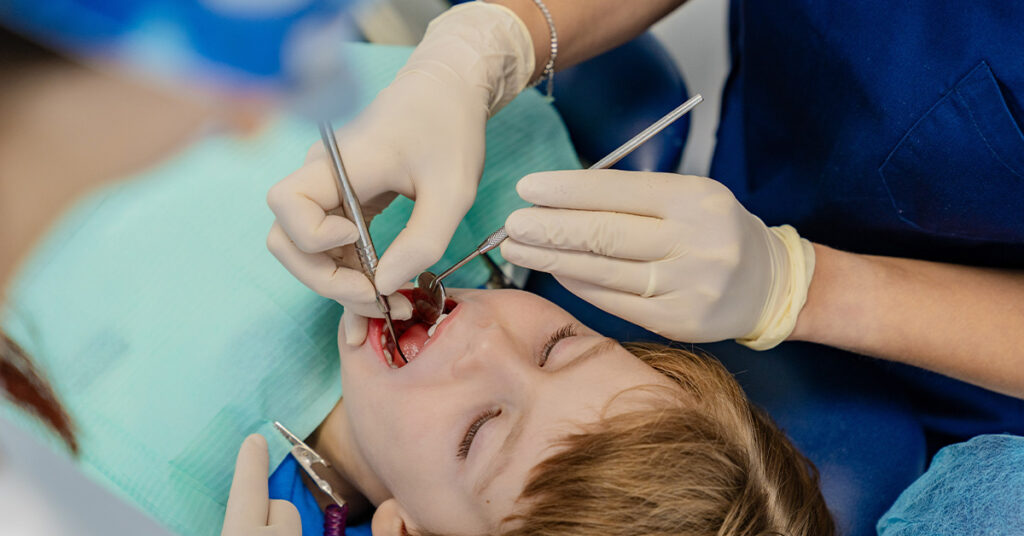 Cura tempestiva delle carie nei denti da latte