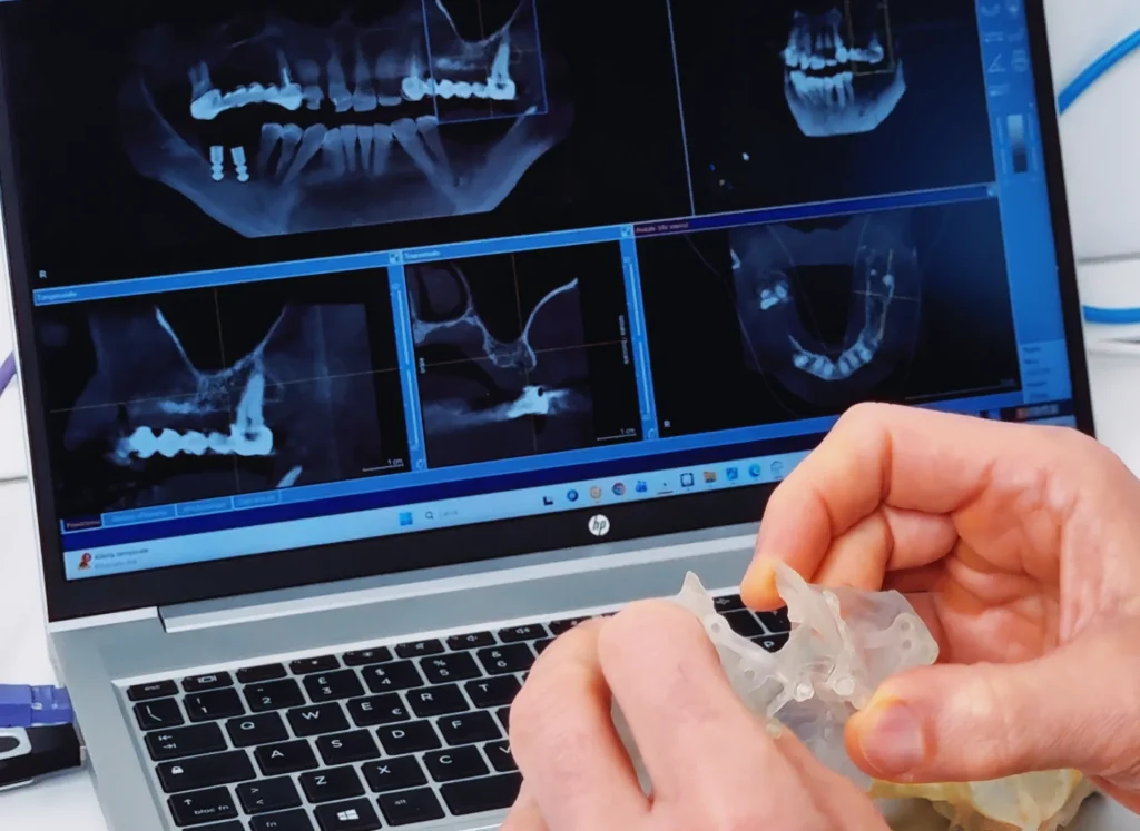 overdenture su impianti