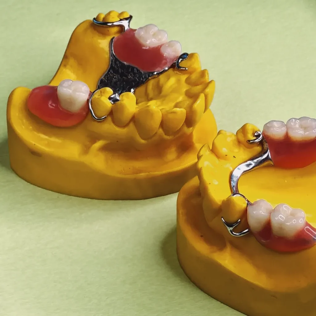Protesi e dentiera a Mozzecane - overdenture su impianti