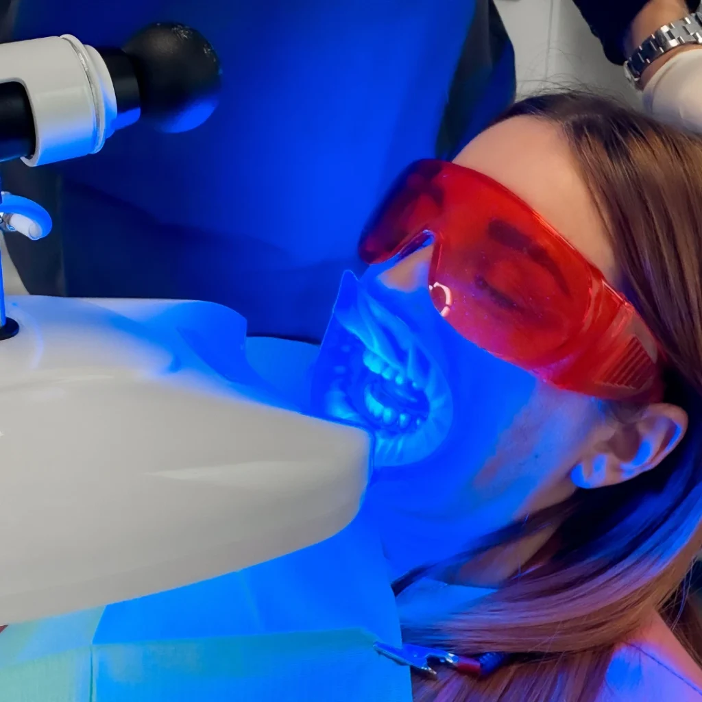 Sbiancamento dentale a Mozzecane