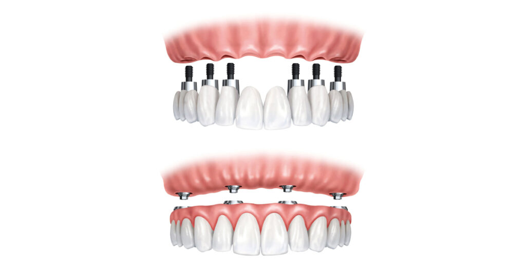 protesi fissa su impianti