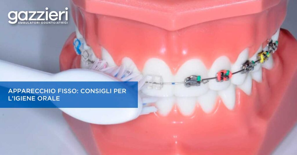 Ambulatori Gazzieri - News - Come pulire l’apparecchio fisso