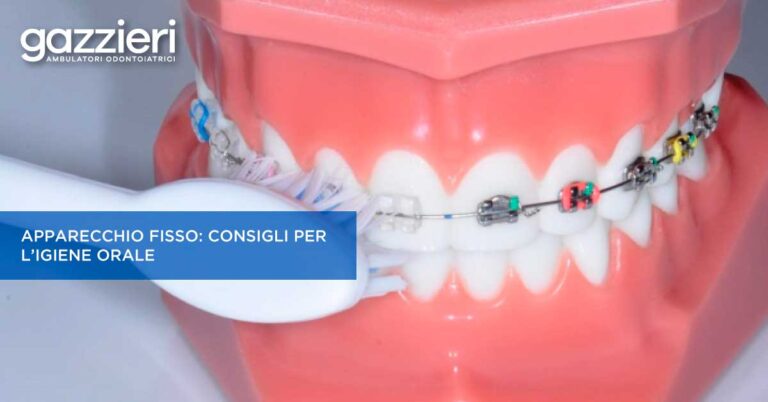 Ambulatori Gazzieri - News - Come pulire l’apparecchio fisso